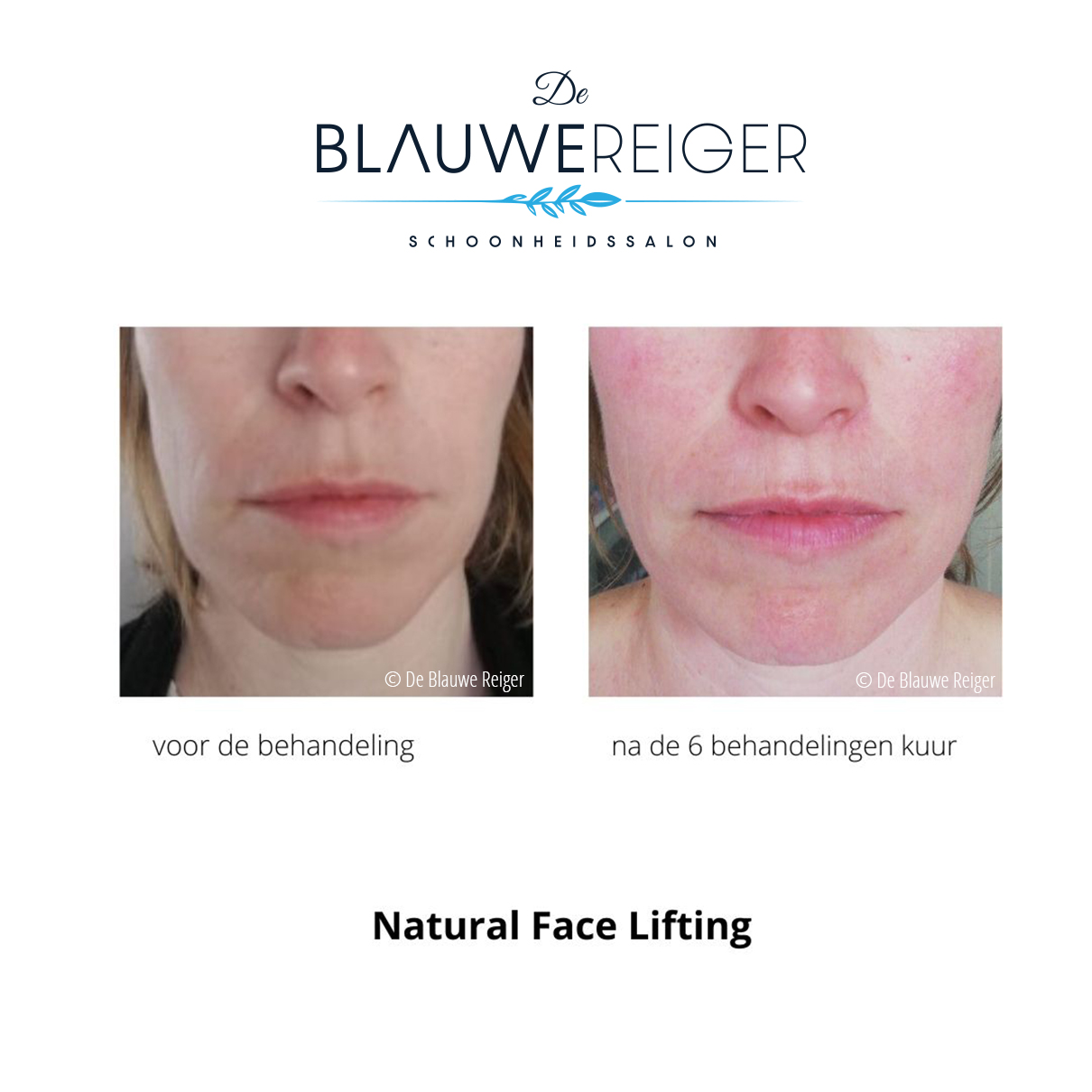 de blauwe reiger greenpeel natural face lifting